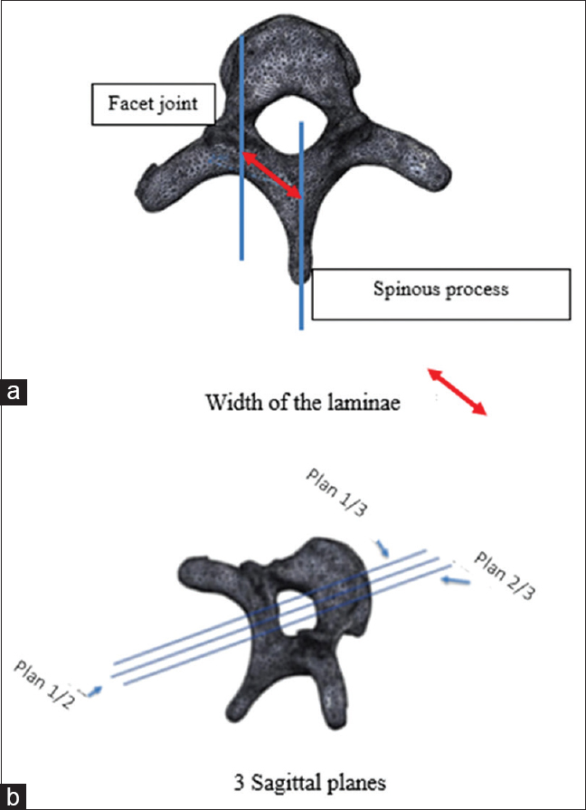 (a) Width of the laminae, (b) 3 Sagittal planes