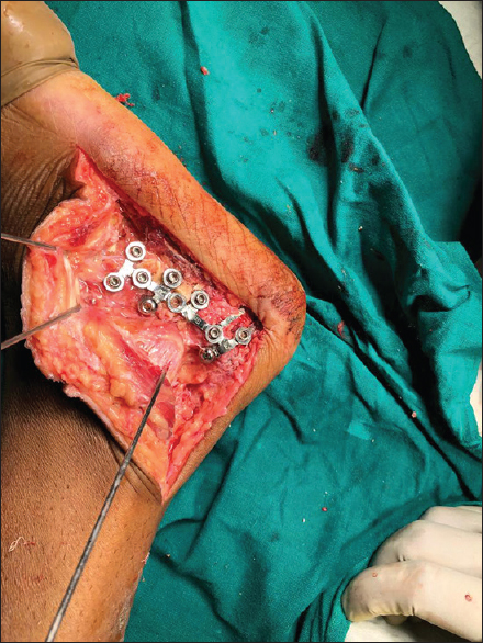 Intraoperative photograph showing final fixation of fracture with contoured locking calcaneal plate