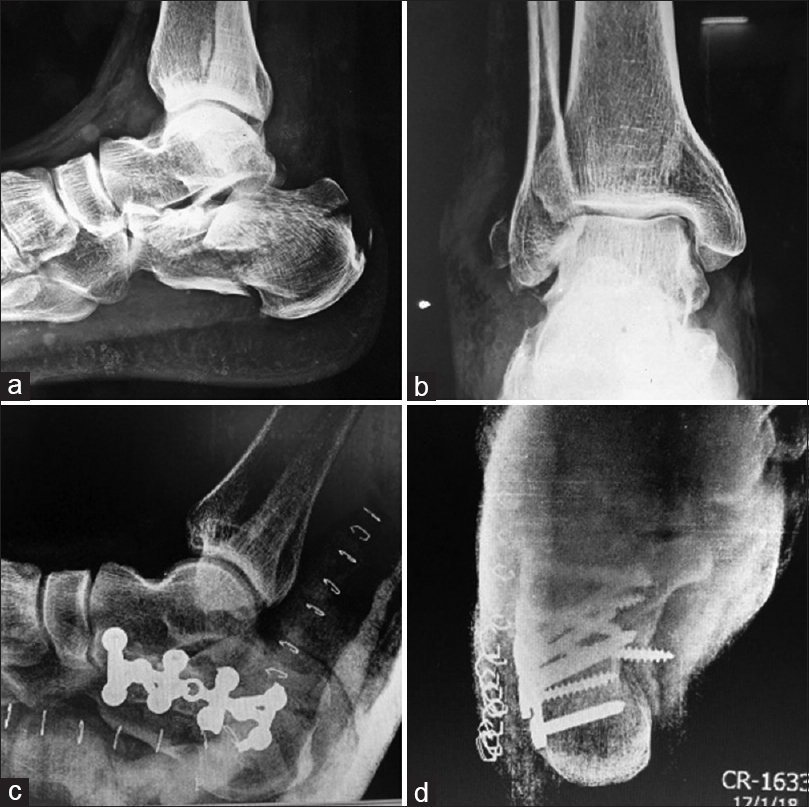 Anteroposterior (a) and lateral (b) views of ankle in a 45-year-old male having intra-articular calcaneum fracture. Patient was operated with open reduction and fixation with locking calcaneal plate. Immediate post-operative lateral (c) and axial (d) views of calcaneum of the same patient