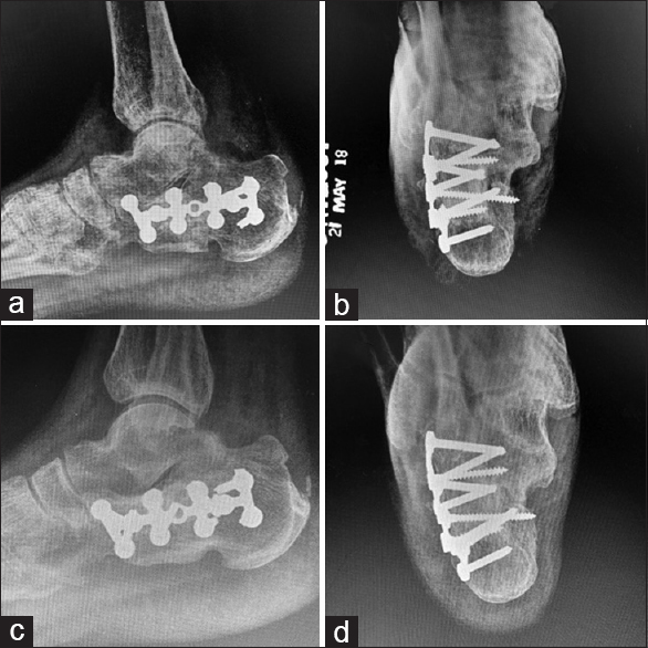 Follow up X-rays (lateral and axial views) of the patient showing progressive union at 4 months following surgery (a and b) and solid union of the fracture at postoperative 8 months (c and d)