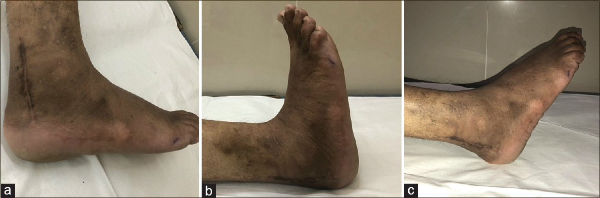 (a) wound healed without complications and (b and c) postoperative ankle dorsiflexion and plantar flexion