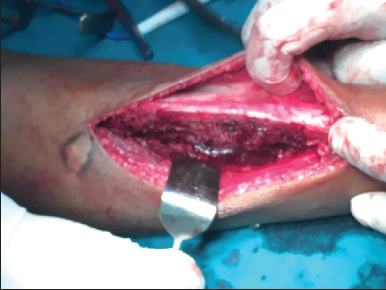 Remaining tibial shaft post excision