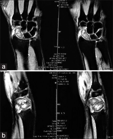 The magnetic resonance imaging showing marrow edema and destruction of scaphoid and surrounding extensive soft-tissue edema in T1 coronal (a) and sagittal views (b)