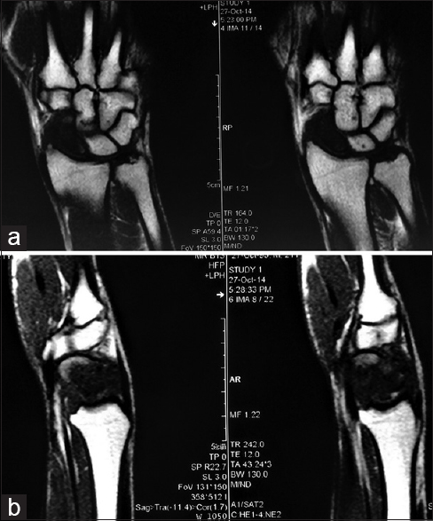 The same lesion is hypointense in fat-suppressed coronal (a) and sagittal T1 view showing the altered signal and destruction of scaphoid (b)