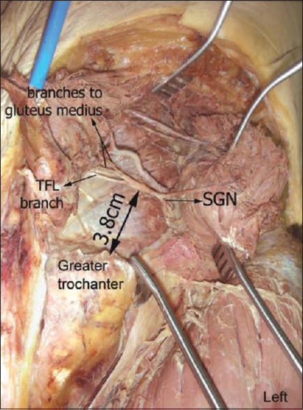 Relation of the tip of the greater trochanter (Image courtesy of Dr. Nihal Apaydin)