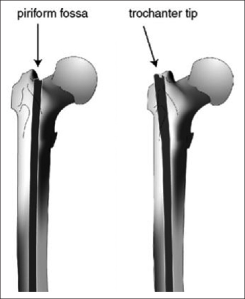 Entry points of a cephalomedullary femoral nail (Image courtesy of Dr. Ansari Moein)