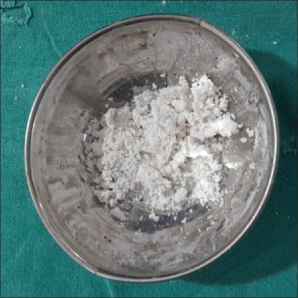 Mixture of calcium sulfate and vancomycin mixed with NS (sodium chloride 0.9%) to the shown consistency