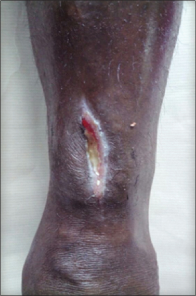 Image of the distal leg above the ankle showing discharging sinus with evidence of attempted curettage