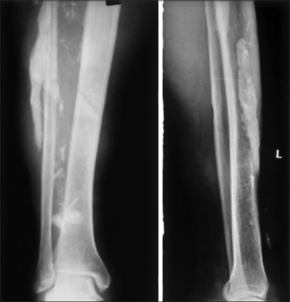 Preoperative radiograph anteroposterior and lateral view showing tibia and fibula along with myositis mass