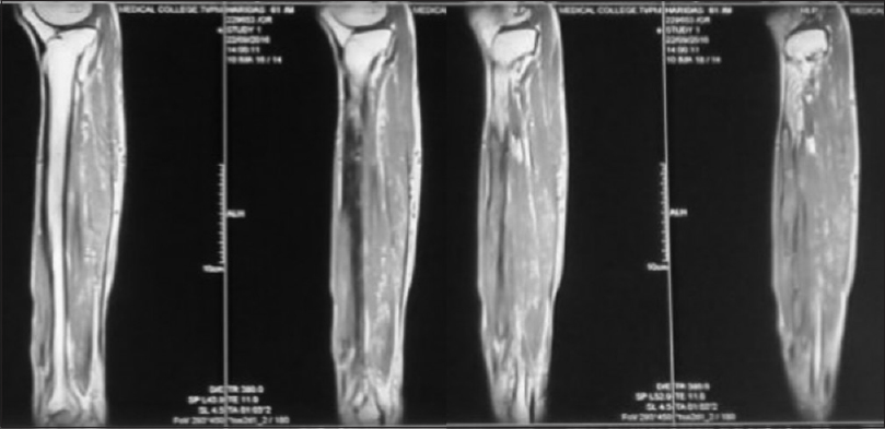 Preoperative magnetic resonance imaging pictures of the leg with myositis mass