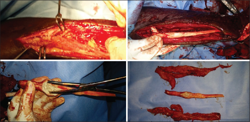 Intraoperative pictures showing the excised myositis mass