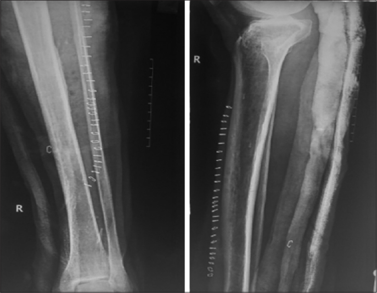 Postoperative radiograph showing no residual myositis mass