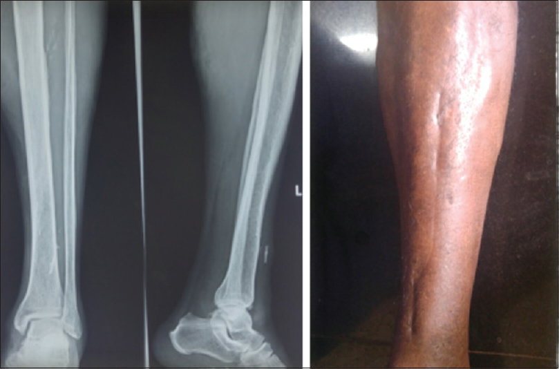 Radiograph and clinical images at final follow-up showing healed wound