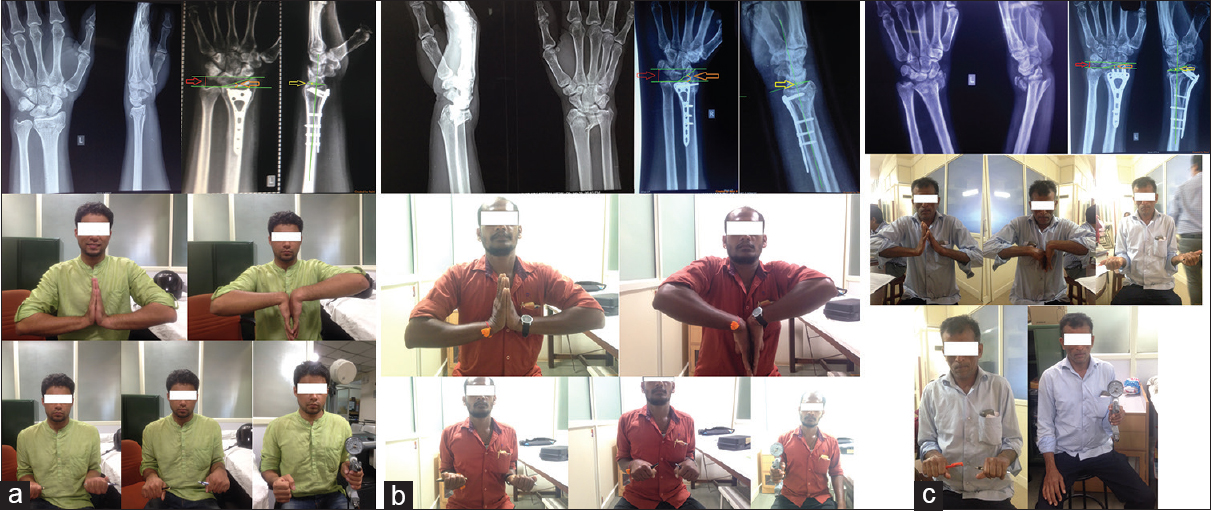 (a) Postoperative excellent functional outcome. Pre- and post-operative X-ray with radial height (red), radial inclination (orange), and volar tilt (yellow). Clinical assessment of range of motion – extension, flexion, supination, pronation, and measurement of grip strength. (b) Postoperative poor functional outcome. Pre- and post-operative X-ray with radial height (red), radial inclination (orange), and dorsal tilt (yellow). Clinical assessment of range of motion – extension, flexion, supination, pronation, and measurement of grip strength. (c) Postoperative good functional outcome. Pre- and post-operative X-ray with radial height (red), radial inclination (orange), and volar tilt (yellow). Clinical assessment of range of motion – extension, flexion, supination, pronation, and measurement of grip strength