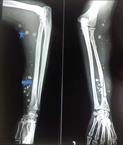 X-ray of the forearm with elbow and wrist with intramuscular swelling (bracket) and calcified thrombus as phlebolith (star) and cortical thickening (arrow)