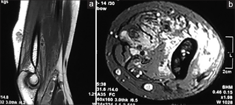 T1-weighted coronal section (a) shows the increased signal intensity due to fat content and area with low signal intensity is due to fibrous tissue or calcified thrombi or phlebolith. T2-weighted axial images (b) shows increased signal intensity in “bag of worm” or tubular appearance