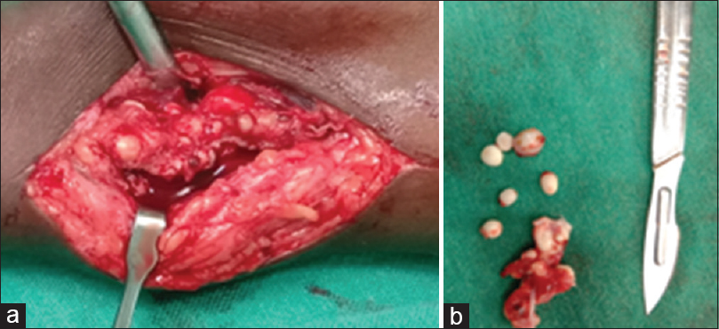 Intraoperative image (a) showing hemangioma and (b) dissected out phleboliths