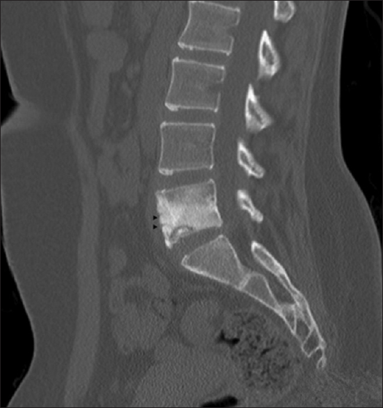 Computed tomography scan sagittal image of the L5 vertebral body showing (with arrow) multiple grooves in the lower part of body