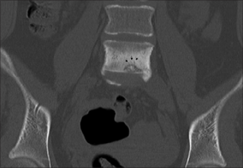 Computed tomography scan coronal image of the L5 vertebral body showing (with black arrow head) multiple grooves in the lower part of vertebral body