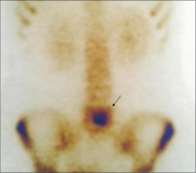 Bone scan showing increased uptake in the L5 vertebral body