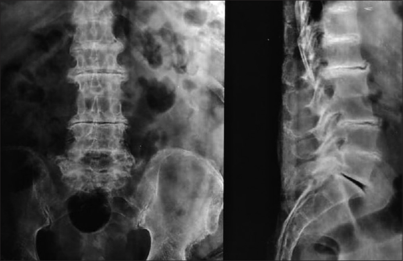 X-rays of the lumbar spine showed bony ankylosis at D12–L1, L2–3, and L4–5 levels with loss of lordosis and sclerosis at the end plates of L1–2, L3–4, and L5–S1 levels