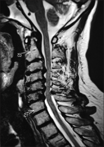 Magnetic resonance imaging showed C3–4, C4–5, C5–6, and C6–7 disc protrusions with cervical spinal cord compression with signal changes suggestive of myelomalacia at C6–7 level due to additional ligamentum flavum thickening/calcification