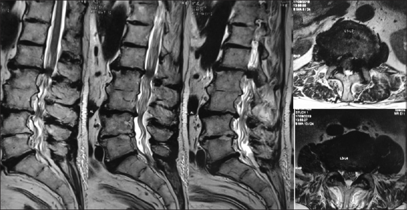 Magnetic resonance imaging showed L1–2 and L3–4 lumbar canal stenosis due to hypertrophy of the ligamentum flavum and facet arthropathy