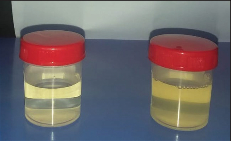 The color of the patient's urine turned dark after exposure to air after 2 h