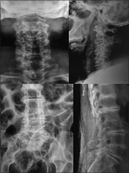 Postoperative X-rays showed the C3–C7 and L1–L3 laminectomy defects