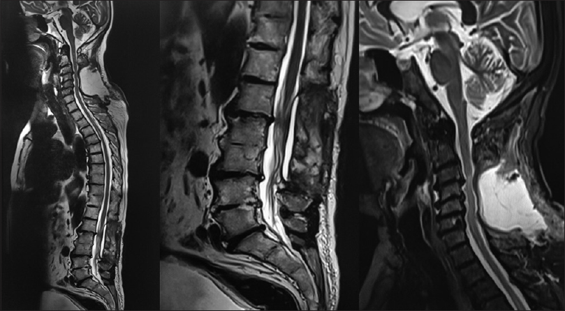 Magnetic resonance imaging showing adequate decompression