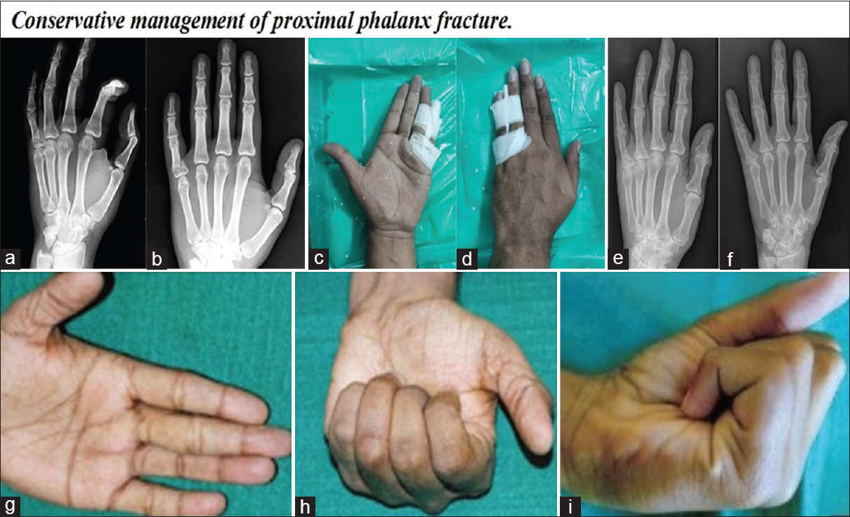 Preoperative oblique and AP radiograph of proximal phalanx base fracture of left hand little finger (a and b). Buddy strapping little and ring finger (c and d). Postoperative 6th month radiograph (e and f). Hand functions at 6th month (g-i)