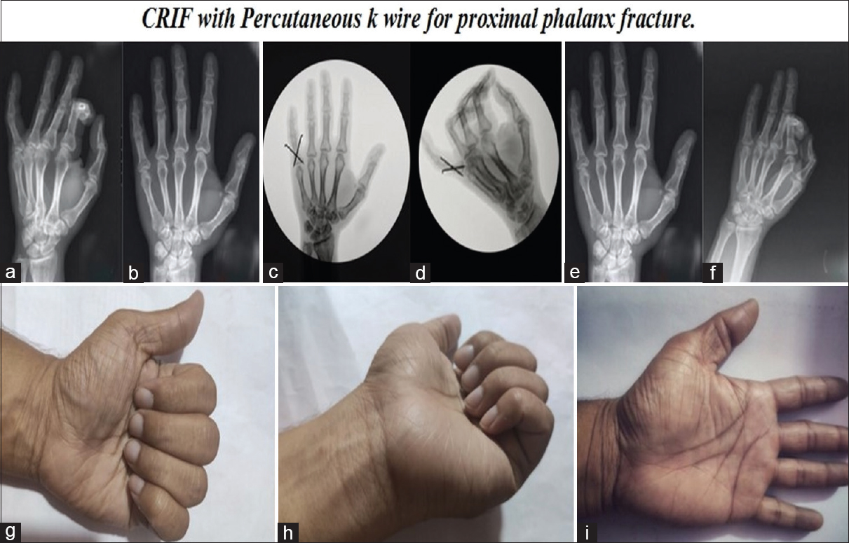 Preoperative oblique and AP radiograph of the right hand little finger proximal phalanx base fracture (a and b). Intraoperative C-arm images (c and d). Radiograph after 6th month (e and f). Hand functions at 6th month (g-i)