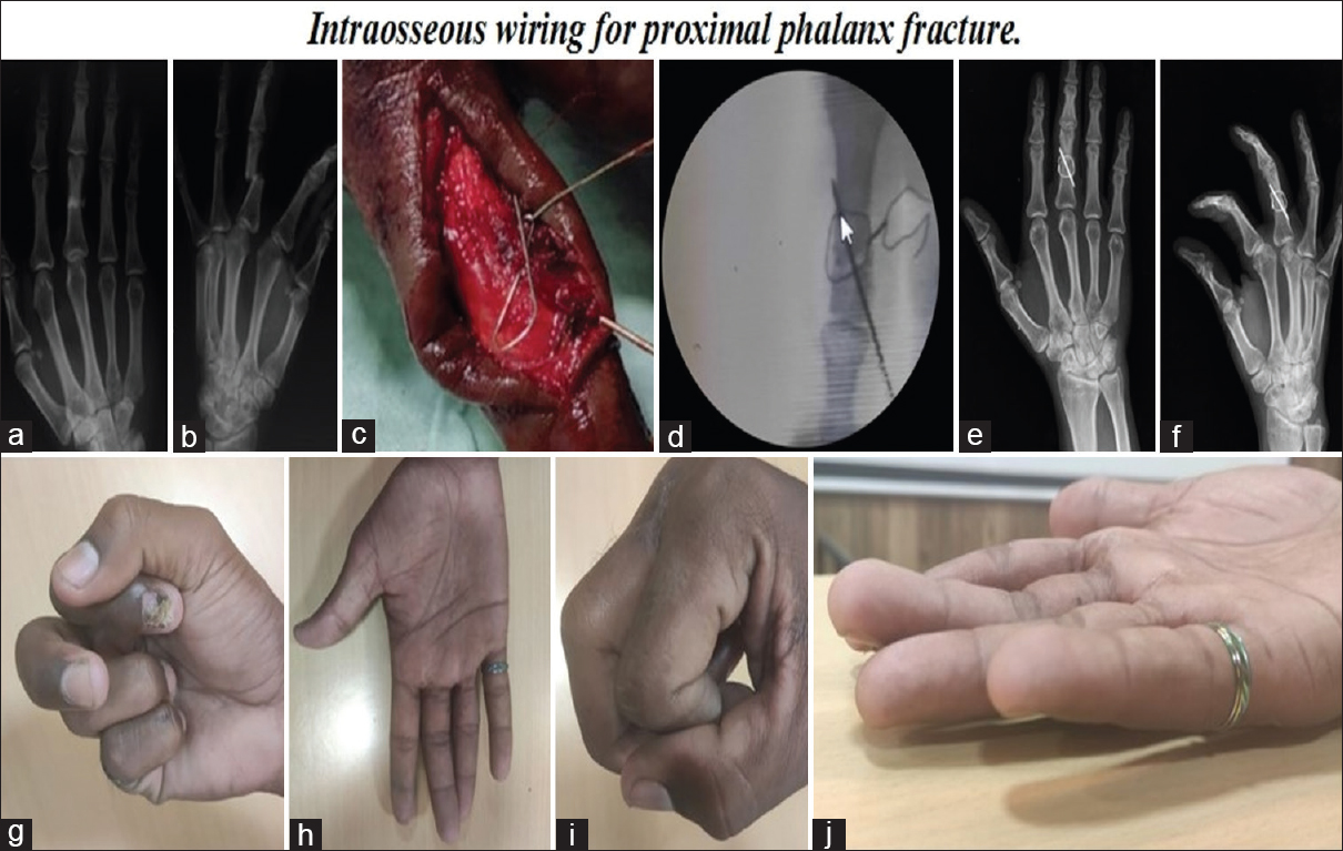 Preoperative AP and oblique radiograph of proximal phalanx shaft fracture right hand middle finger (a and b). Intraoperative clinical and C-arm image (c and d). Postoperative 6th month radiograph (e and f). Hand functions at 6th month (g-j)