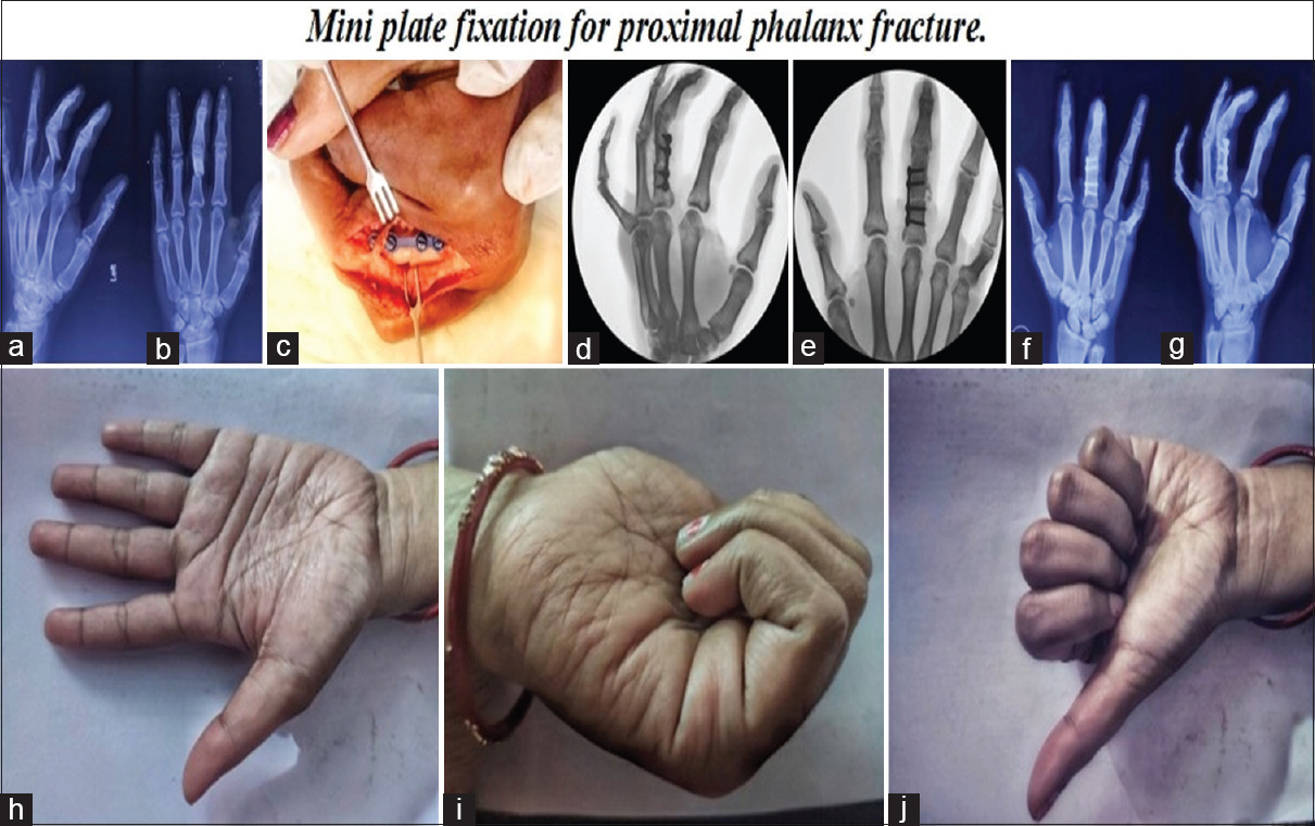 Preoperative AP and oblique radiograph of proximal phalanx shaft fracture middle finger (a and b). Intraoperative clinical and C-arm image (c-e). Postoperative 6th month AP and oblique radiograph (f and g). Hand functions at 6th month (h-j)