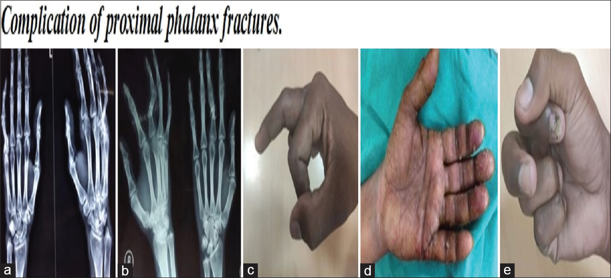 Complication of proximal phalanx fracture. (a) Malunion of conservative management. (b) Implant failure of interosseous wiring. (c) Flexion lag of percutaneous k wire. (d) CRPS of percutaneous K wire. (e) Crowding of intraosseous wiring