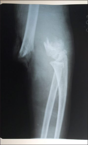 Radiograph showing displaced supracondylar fracture of humerus