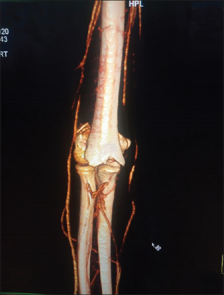 Computed tomography angiogram with interrupted circulation in brachial artery