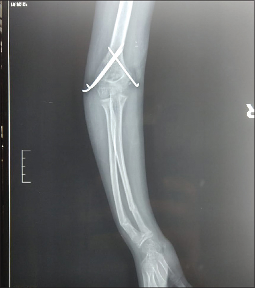 Radiograph showing fracture fixation using crossed K-wires and fracture distal one-third both bone forearms managed conservatively