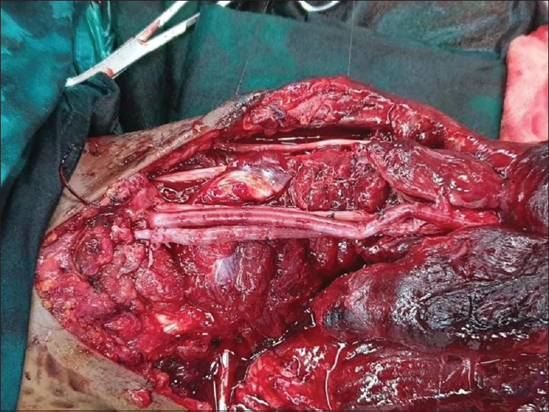 Per-operative picture showing repaired brachial artery using reverse-interpositional saphenous vein graft (arrow)