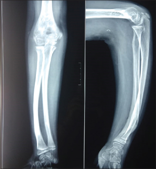 Radiograph of united supracondylar and distal one-third both bone fracture after 3 months of injury