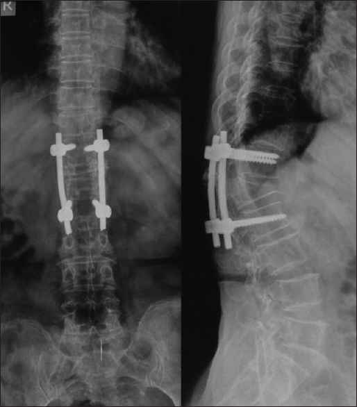 The X-ray showed partial backing out of screws and osteolysis around the threads in the vertebral body