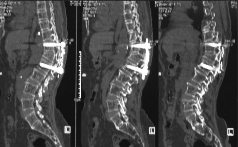 Computed tomography scan showed marginal lysis around the proximal pedicle screws suggestive of implant loosening