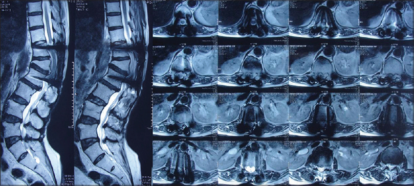 Magnetic resonance imaging did not reveal any neural compression