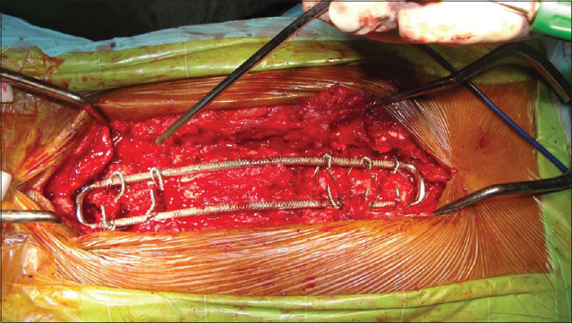 Good graft bed preparation is done for posterior fusion