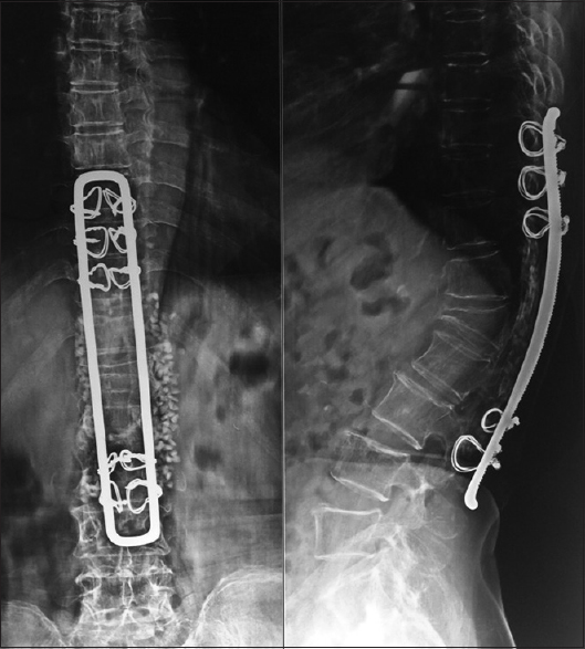 The X-ray revealed improved sagittal balance breaking of the loop rod