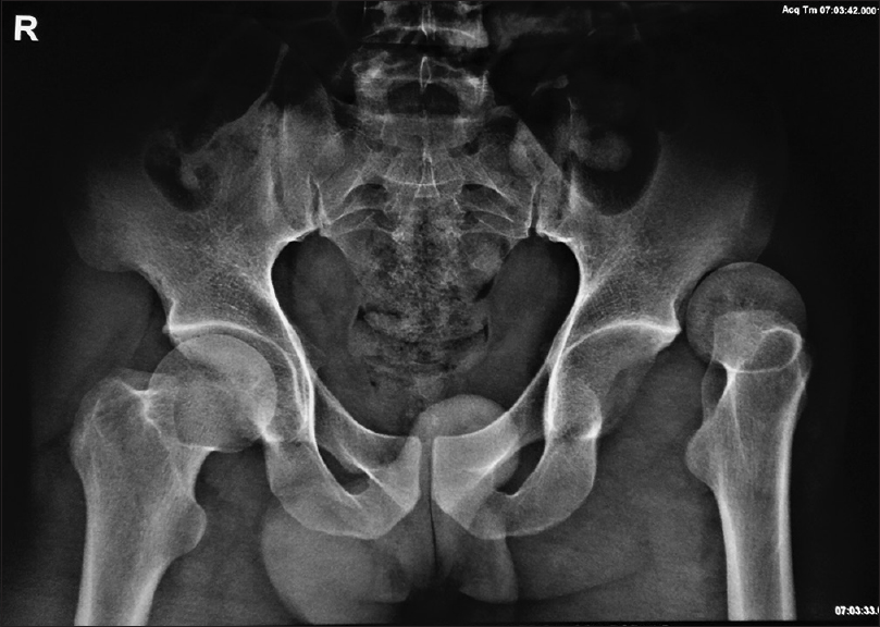 The radiograph showing superior dislocation of the left femoral head out of the acetabulum. The femoral head is seen resting adjacent to the ipsilateral iliac bone. There is no associated bony injury