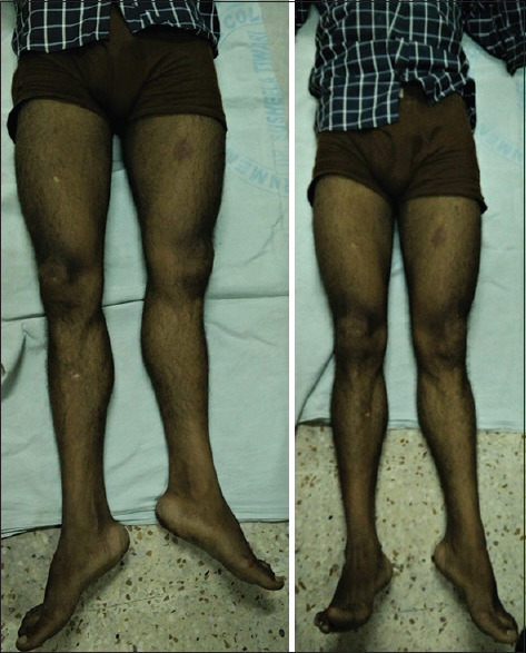 The clinical image before reduction (first image) showing left lower limb shortening with mild external rotation of the limb suggestive of proximal migration of femur. Regain of length is noted after clinical reduction (second image)