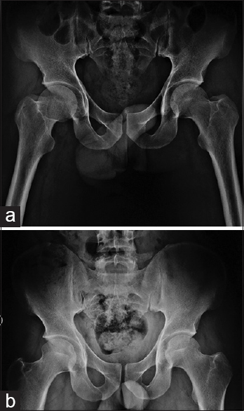 The postreduction radiograph (a) showing a well reduced, concentric hip joint. Radiograph in the follow-up showing stable joint with no recurrence or signs of osteonecrosis (b)