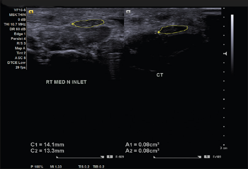 Right median nerve at inlet and at carpal tunnel