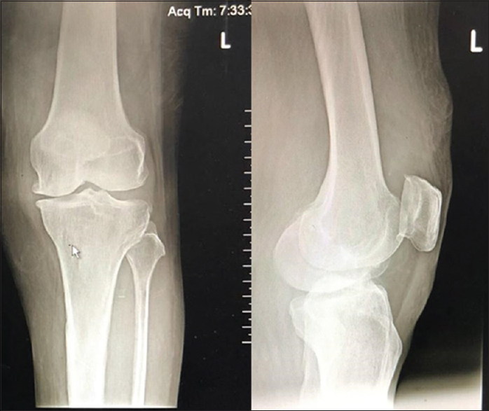 Radiograph (anteroposterior and lateral view) of the left knee of the patient with Grade 2 osteoarthritis knee with joint space narrowing and osteophytic lipping